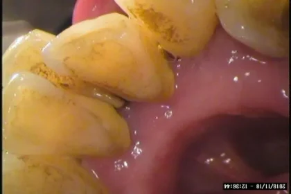 歯石を放っておくと・・😧